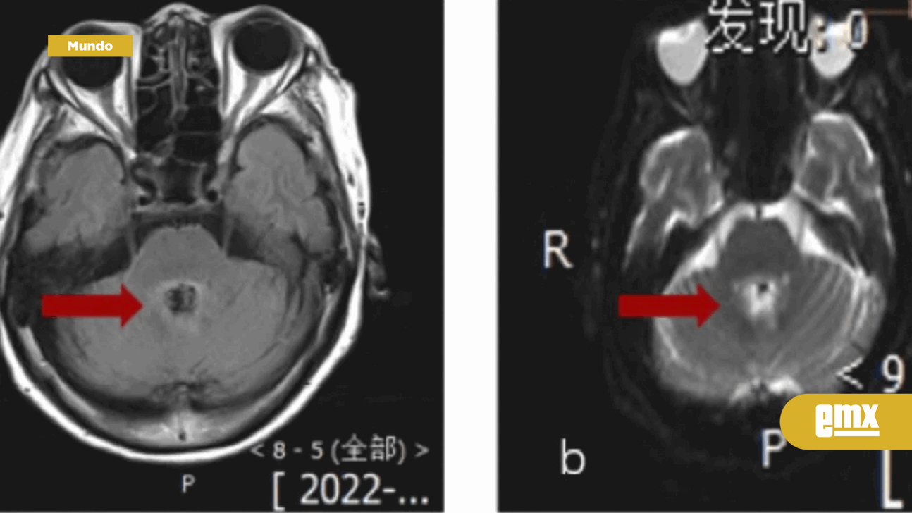 EMX-Diagnostican a abuelita con cáncer cerebral; ameba la devoraba en China