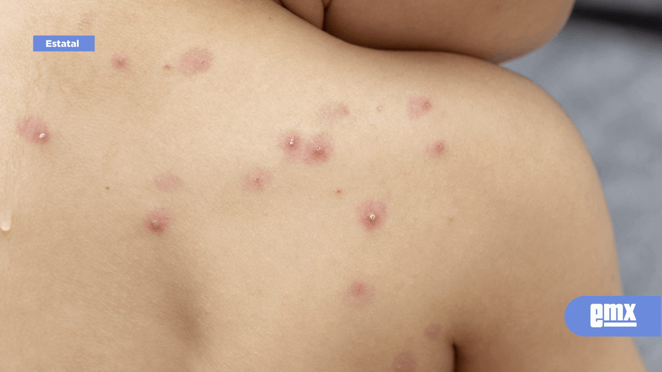 EMX-Viruela del Mono: Baja California reporta caso sospechoso