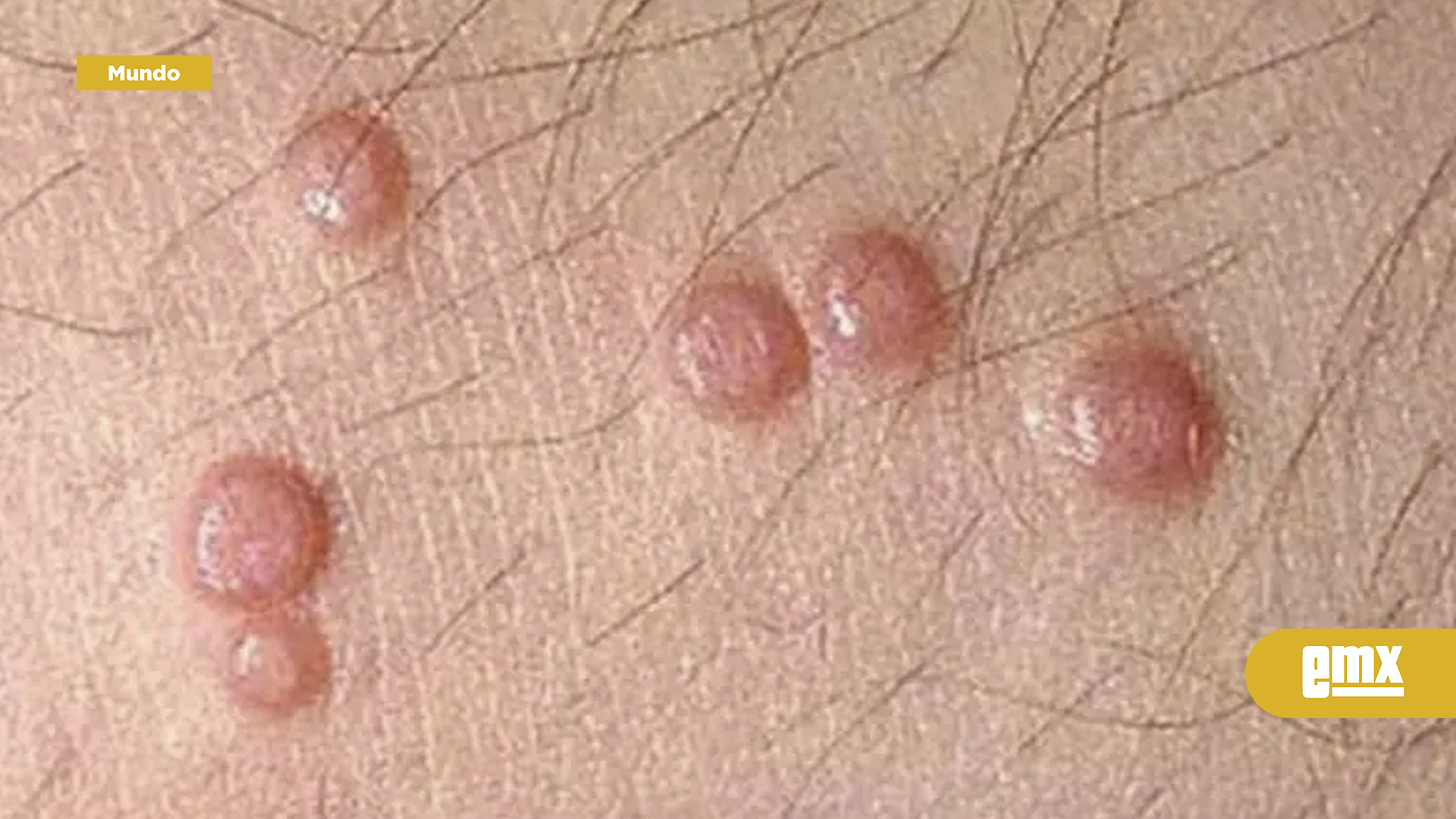 EMX-Qué-es-el-molusco-contagioso;-esto-debes-saber-sobre-el-virus