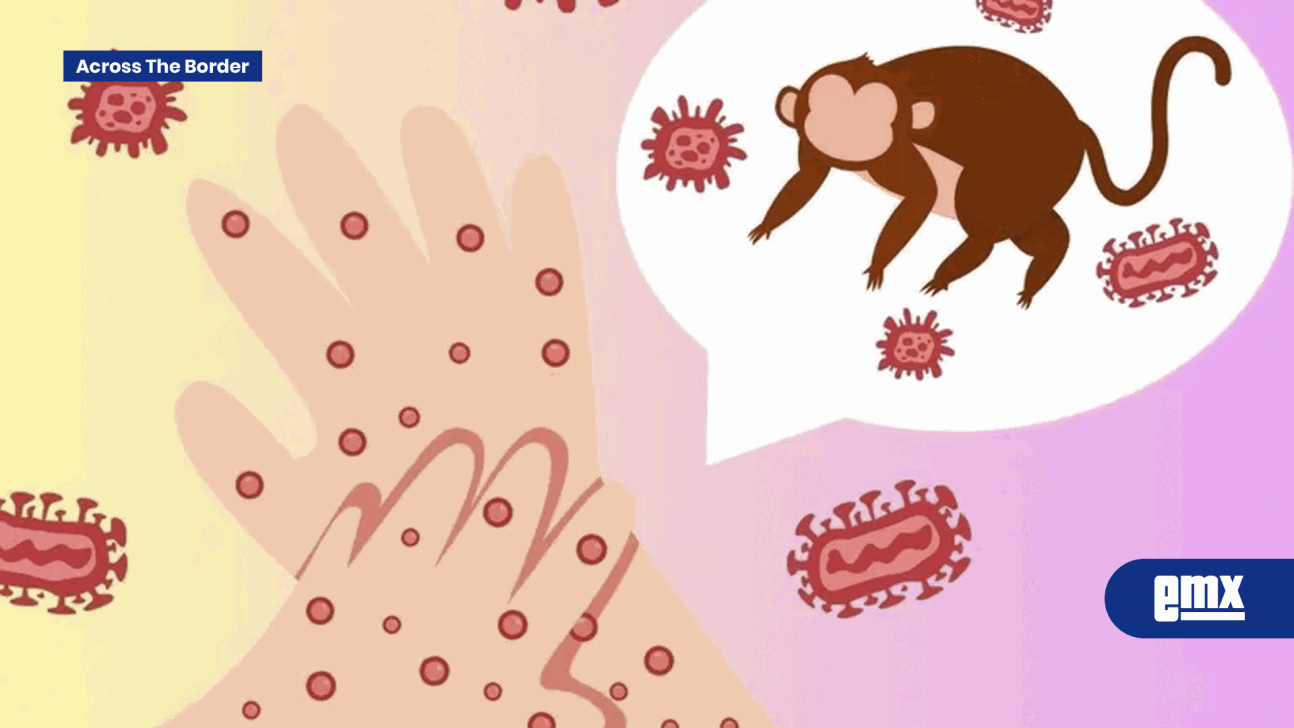 EMX-Cepa más grave de mpox detectada por primera vez en Los Ángeles