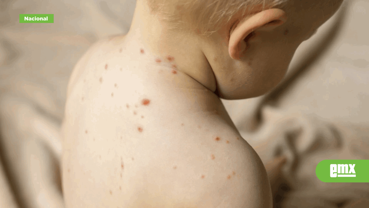 EMX-Brote-de-sarampión-en-México,-en-proceso-de-contención:-Ssa