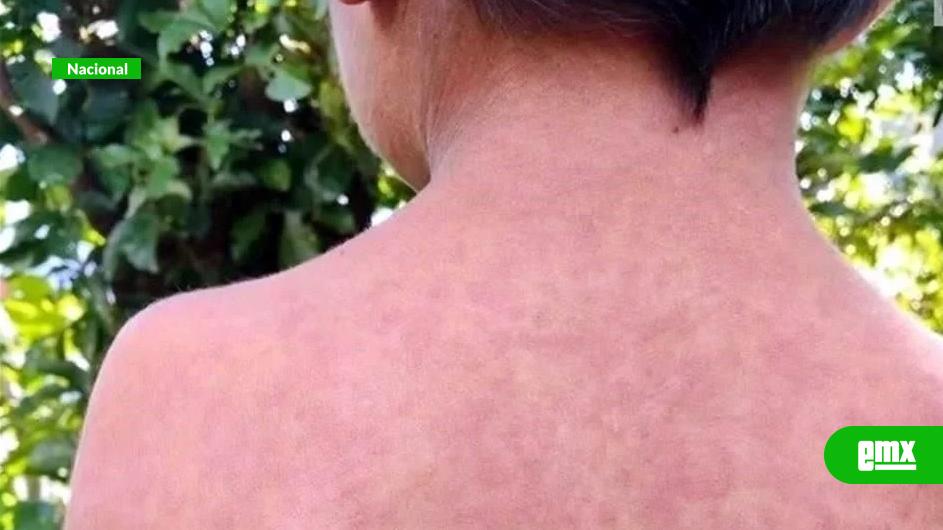 EMX-Fallece-niño-de-8-años-por-sarampión-en-Durango