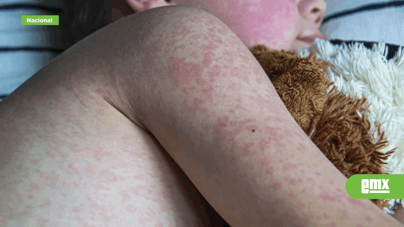 EMX-Van-31-muertos-por-sarampión-en-México;-hay-más-de-10-mil-casos-confirmados