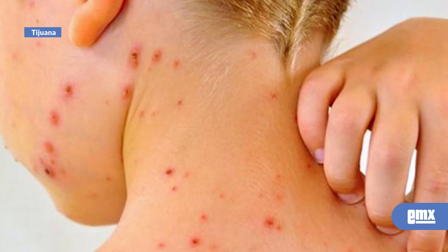 EMX-Ofrece-Certus-Laboratorio-pruebas-para-diagnóstico-oportuno-de-sarampión