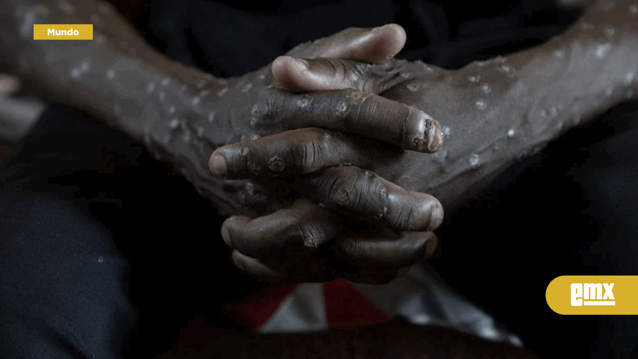 EMX-Congo-declara-fin-de-brote-de-mpox,-tras-dos-años-y-más-de-2-mil-200-muertes