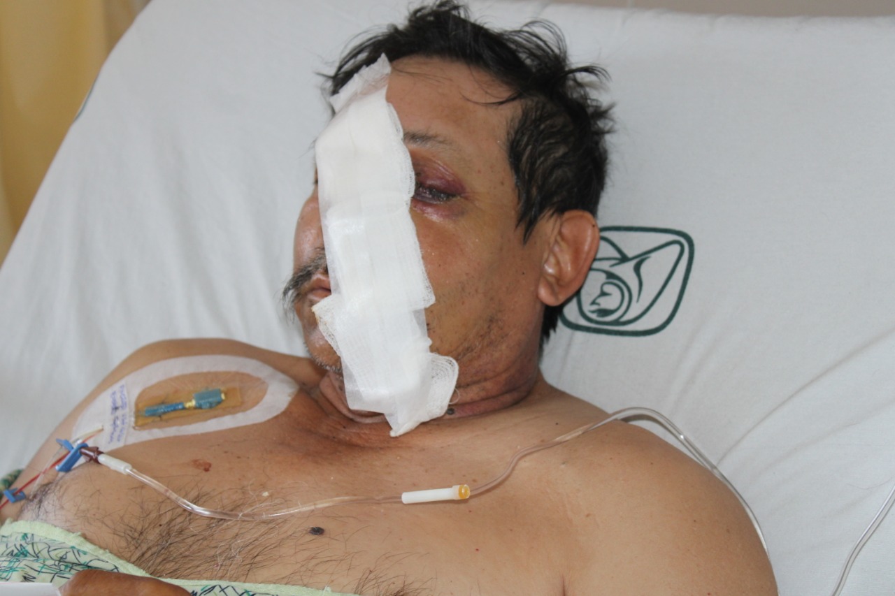 EMX-Retiran especialistas del IMSS BC disco de metal incrustado en rostro de paciente