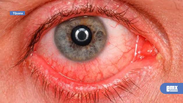 EMX-Uso-excesivo-de-pantallas-dispara-casos-de-ojo-seco-en-jóvenes