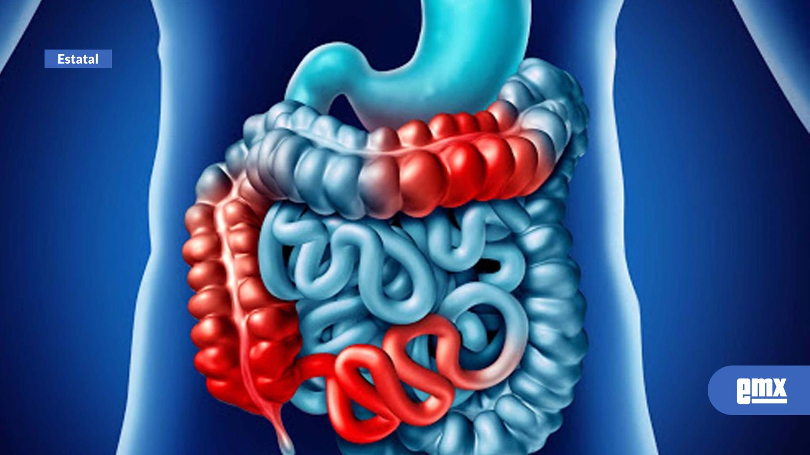 EMX-Enfermedad-Inflamatoria-Intestinal-afecta-principalmente-a-personas-jóvenes