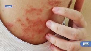 EMX-Comezón persistente podría ser señal de dermatitis atópica y no sólo de piel reseca