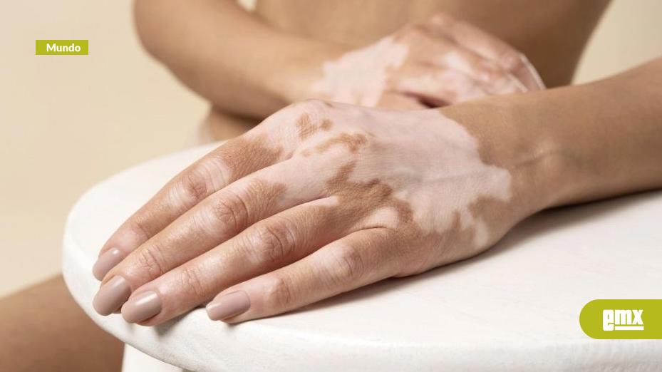 EMX-Emiratos-Árabes-Unidos-aprueba-el-primer-medicamento-oral-contra-el-vitiligo